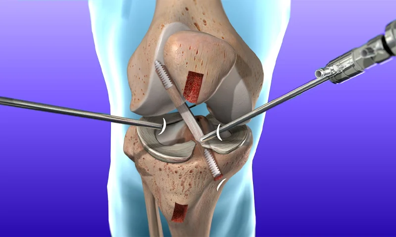 ACL Reconstruction Surgery