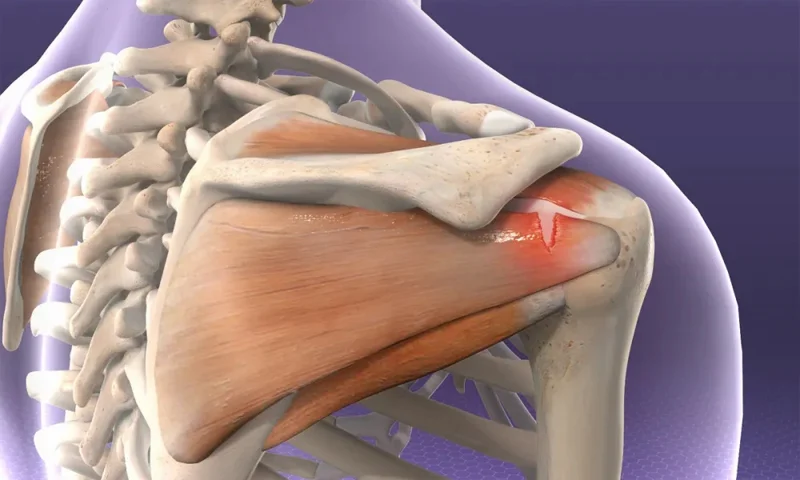 Arthroscopic Shoulder Surgery