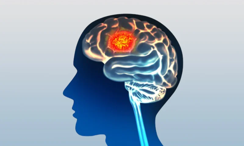 Brain Tumor Surgery