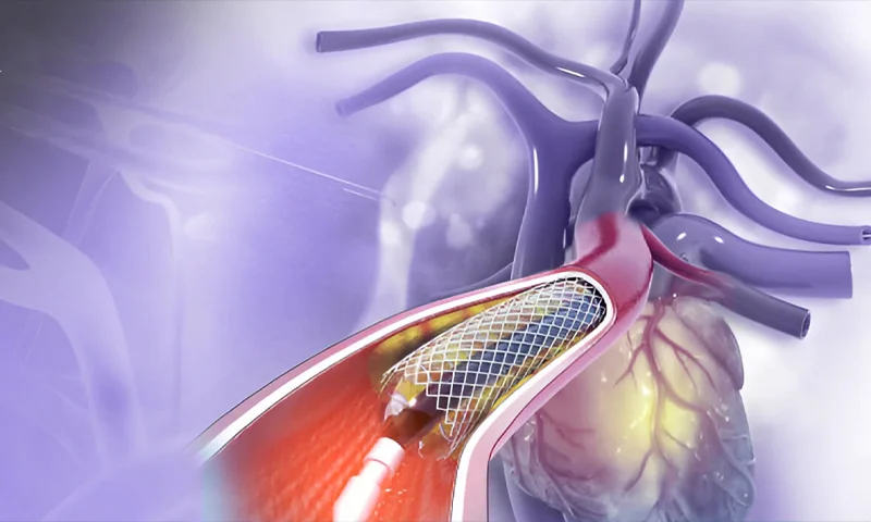 Coronary Angioplasty