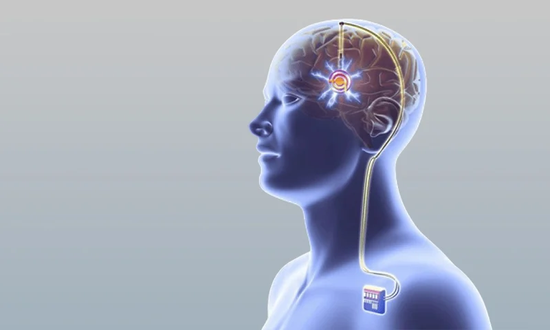 Deep Brain Stimulation