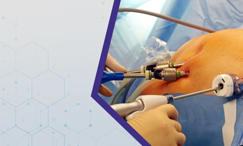 Gallbladder Removal