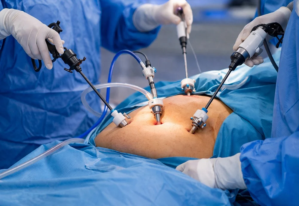 Gastric Sleeve Surgery