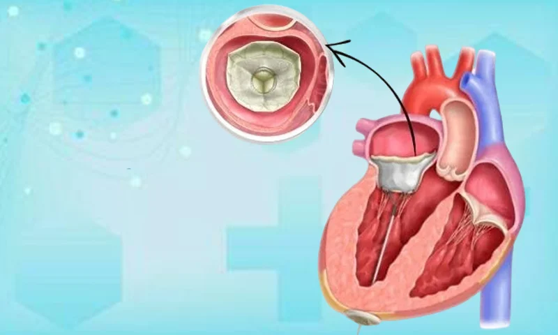 Heart Valve Replacement