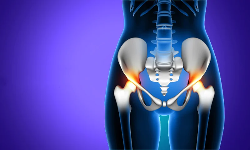 Hip Replacement Surgery