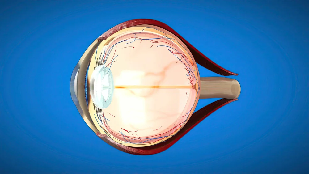 Retinal Detachment Surgery