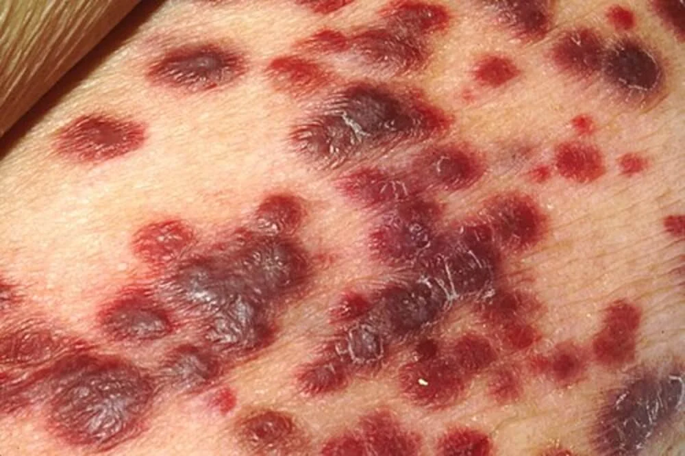 Skin Cancer Removal