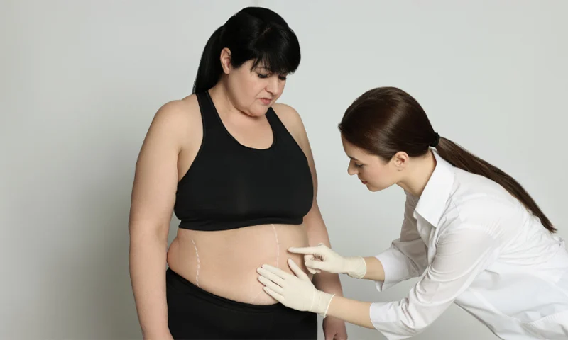 Tummy Tuck (Abdominoplasty)